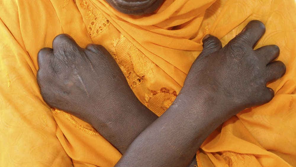 Täglich infizieren sich Menschen mit Lepra