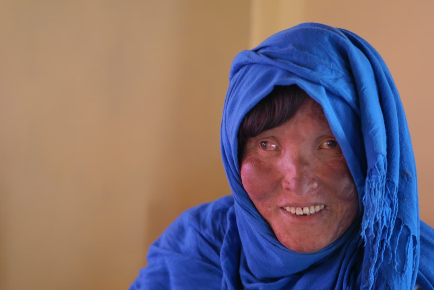 Warum die Lepra noch immer nicht besiegt ist